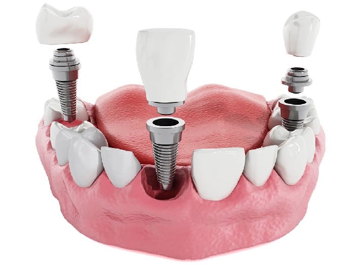 dental implants ashburn va